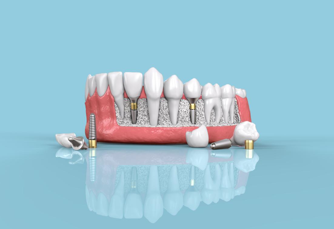 Dental Implants Aberdeen, NJ